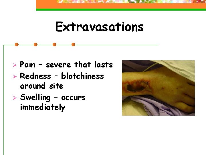 Extravasations Ø Ø Ø Pain – severe that lasts Redness – blotchiness around site