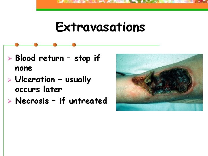 Extravasations Ø Ø Ø Blood return – stop if none Ulceration – usually occurs