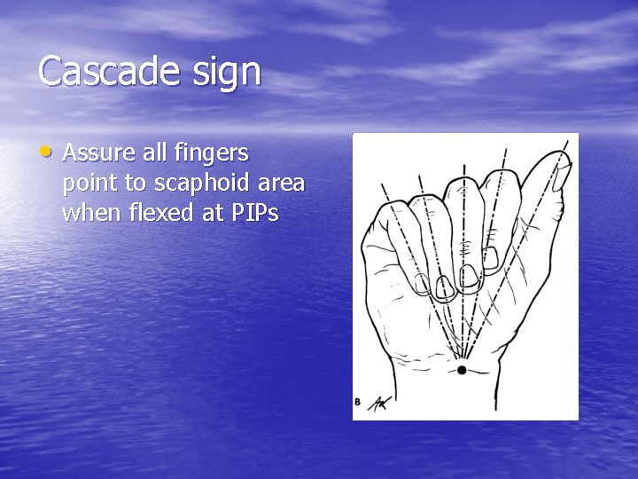 Cascade sign • Assure all fingers point to scaphoid area when flexed at PIPs
