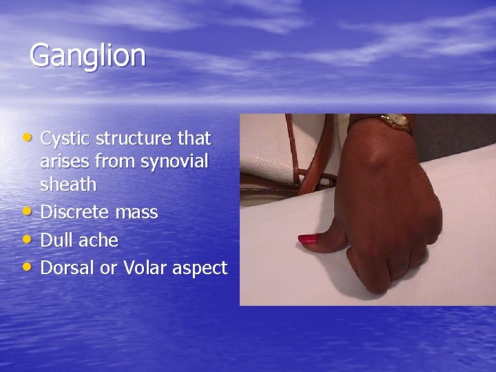 Ganglion • Cystic structure that • • • arises from synovial sheath Discrete mass