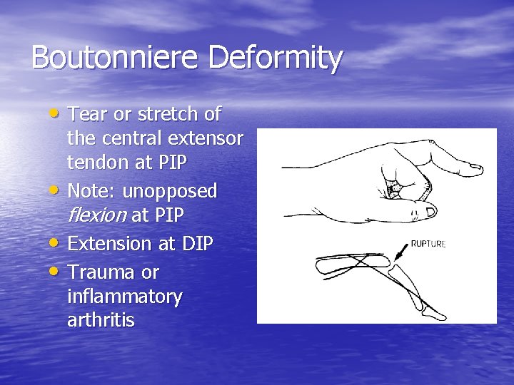 Boutonniere Deformity • Tear or stretch of • • • the central extensor tendon