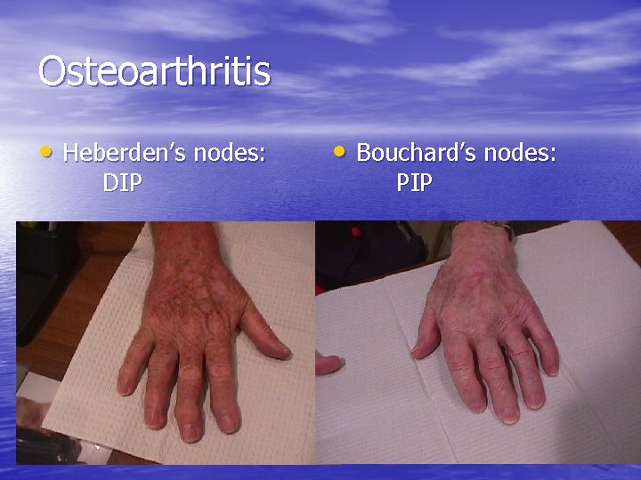 Osteoarthritis • Heberden’s nodes: DIP • Bouchard’s nodes: PIP 
