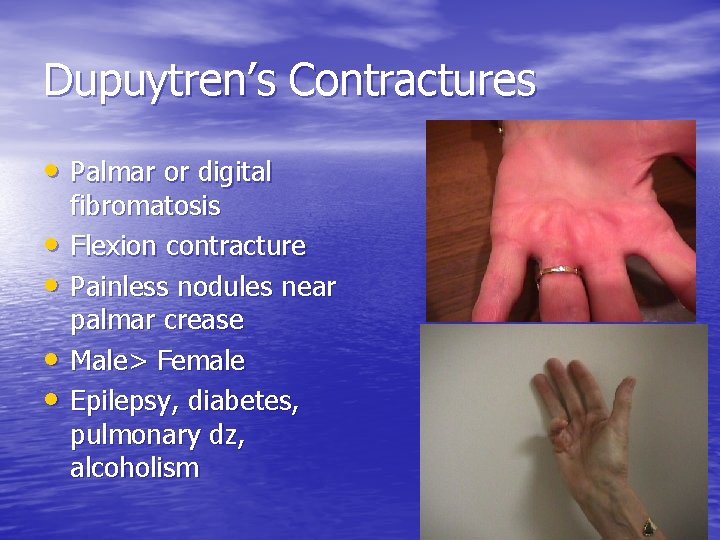 Dupuytren’s Contractures • Palmar or digital • • fibromatosis Flexion contracture Painless nodules near