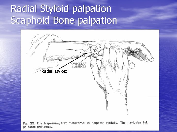 Radial Styloid palpation Scaphoid Bone palpation Radial styloid 