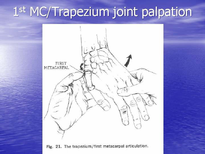 st 1 MC/Trapezium joint palpation 