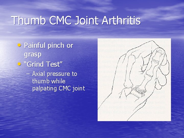 Thumb CMC Joint Arthritis • Painful pinch or • grasp “Grind Test” – Axial