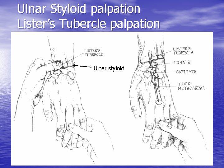 Ulnar Styloid palpation Lister’s Tubercle palpation Ulnar styloid 