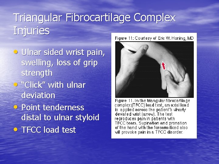 Triangular Fibrocartilage Complex Injuries • Ulnar sided wrist pain, • • • swelling, loss
