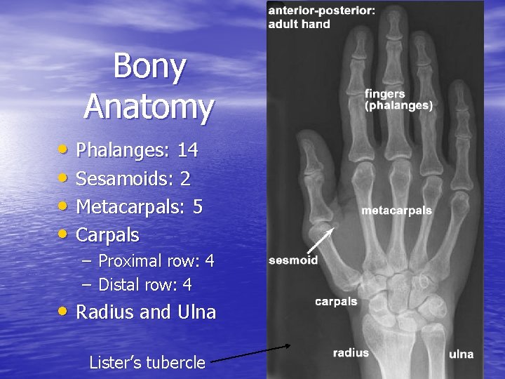 Bony Anatomy • Phalanges: 14 • Sesamoids: 2 • Metacarpals: 5 • Carpals –
