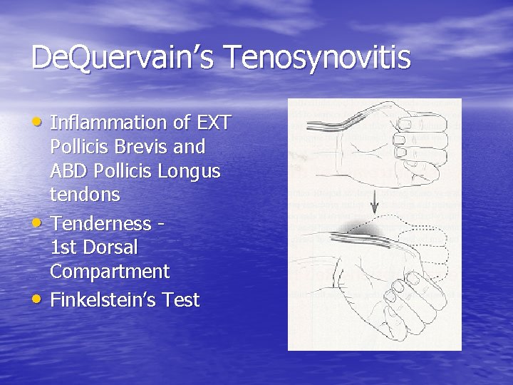 De. Quervain’s Tenosynovitis • Inflammation of EXT • • Pollicis Brevis and ABD Pollicis