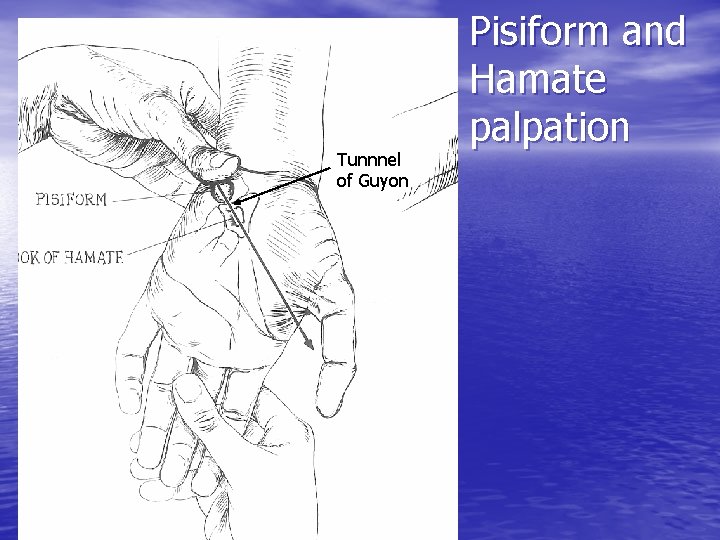 Tunnnel of Guyon Pisiform and Hamate palpation 