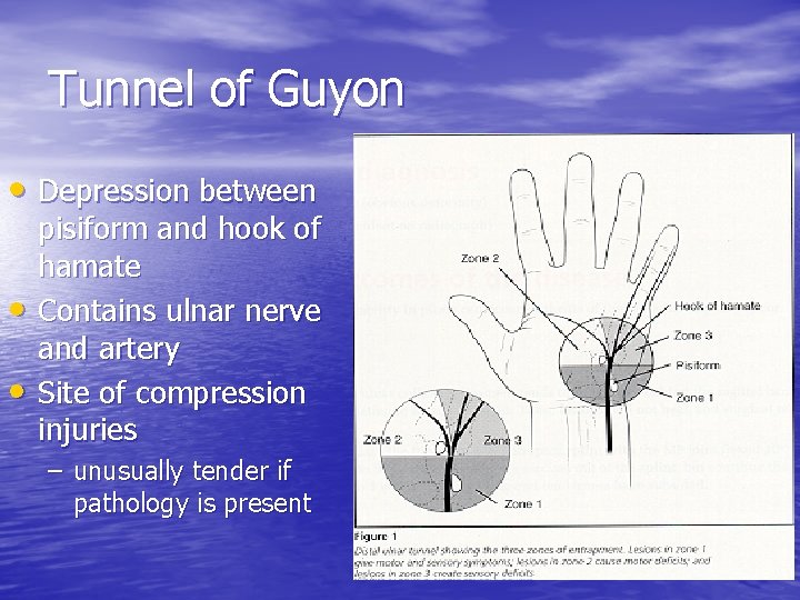 Tunnel of Guyon • Depression between • • pisiform and hook of hamate Contains