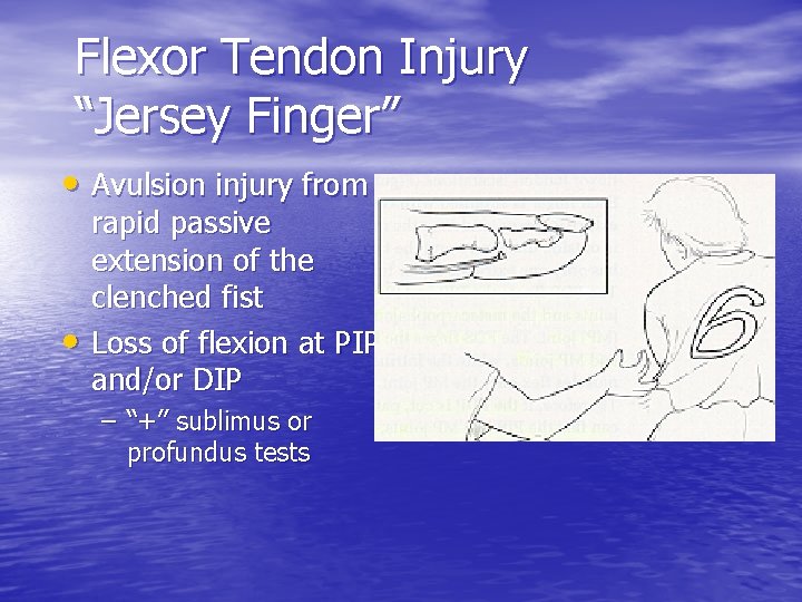 Flexor Tendon Injury “Jersey Finger” • Avulsion injury from • rapid passive extension of