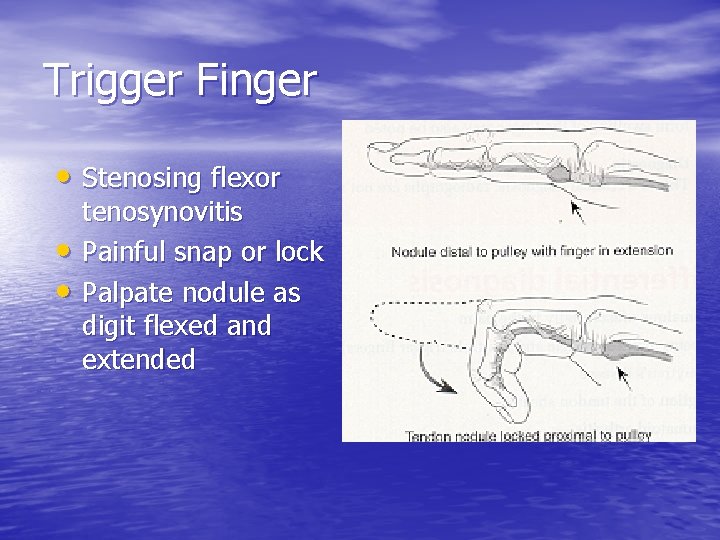 Trigger Finger • Stenosing flexor • • tenosynovitis Painful snap or lock Palpate nodule