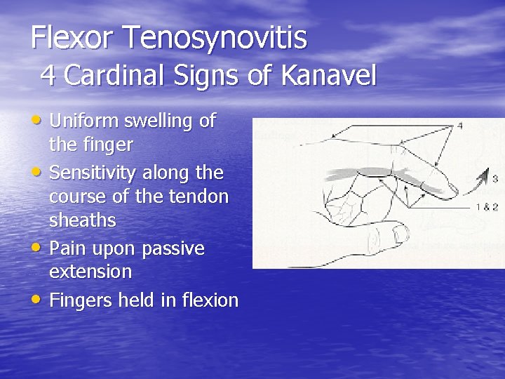 Flexor Tenosynovitis 4 Cardinal Signs of Kanavel • Uniform swelling of • • •