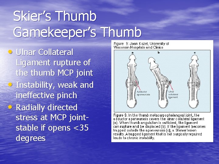 Skier’s Thumb Gamekeeper’s Thumb • Ulnar Collateral • • Ligament rupture of the thumb