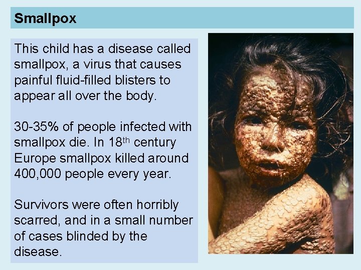 Smallpox This child has a disease called smallpox, a virus that causes painful fluid-filled