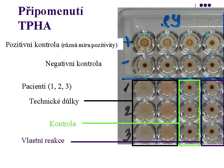 Připomenutí TPHA +++ ++ + +/- Pozitivní kontrola (různá míra pozitivity) Negativní kontrola Pacienti