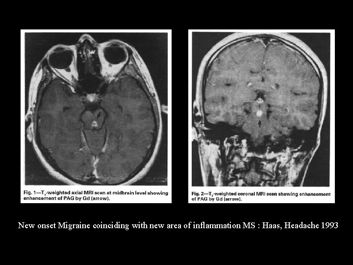 New onset Migraine coinciding with new area of inflammation MS : Haas, Headache 1993
