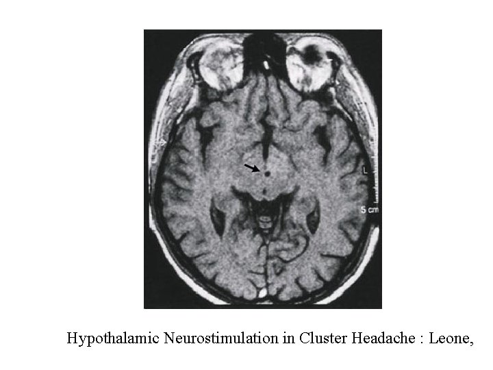 Hypothalamic Neurostimulation in Cluster Headache : Leone, 