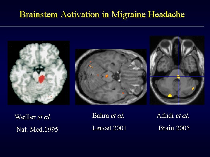 Brainstem Activation in Migraine Headache Weiller et al. Bahra et al. Afridi et al.