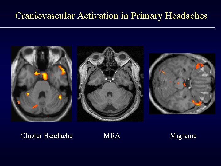 Craniovascular Activation in Primary Headaches Cluster Headache MRA Migraine 