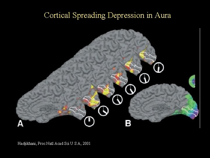 Cortical Spreading Depression in Aura Hadjikhani, Proc Natl Acad Sci U S A, 2001