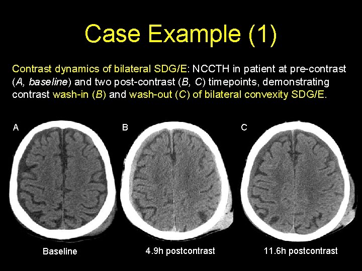 Case Example (1) Contrast dynamics of bilateral SDG/E: NCCTH in patient at pre-contrast (A,