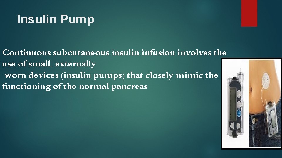 Insulin Pump Continuous subcutaneous insulin infusion involves the use of small, externally worn devices