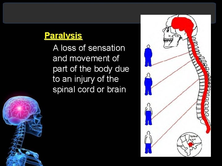 Paralysis A loss of sensation and movement of part of the body due to