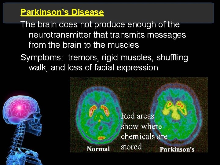 Parkinson’s Disease The brain does not produce enough of the neurotransmitter that transmits messages