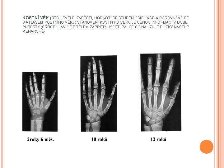 KOSTNÍ VĚK (RTG LEVÉHO ZÁPĚSTÍ, HODNOTÍ SE STUPEŇ OSIFIKACE A POROVNÁVÁ SE S ATLASEM