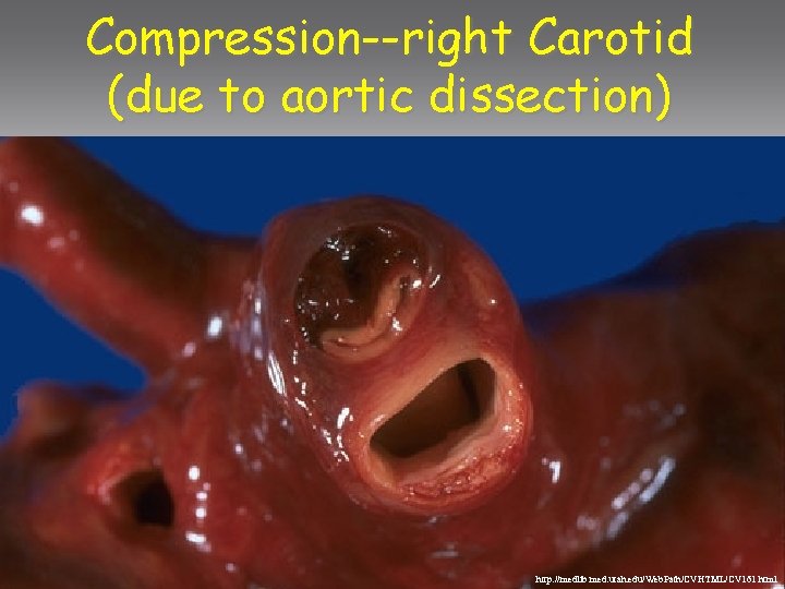 Compression--right Carotid (due to aortic dissection) http: //medlib. med. utah. edu/Web. Path/CVHTML/CV 161. html
