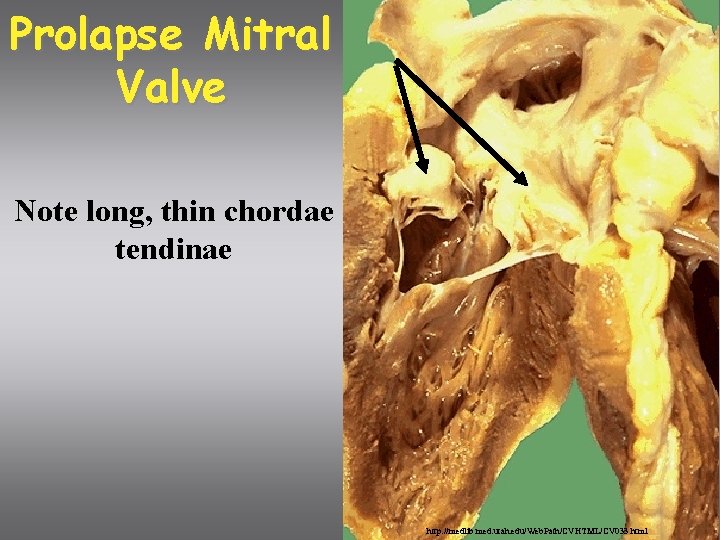 Prolapse Mitral Valve Note long, thin chordae tendinae http: //medlib. med. utah. edu/Web. Path/CVHTML/CV