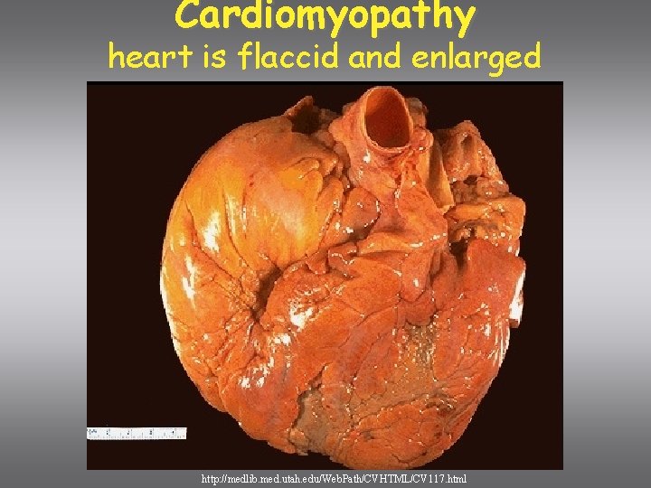 Cardiomyopathy heart is flaccid and enlarged http: //medlib. med. utah. edu/Web. Path/CVHTML/CV 117. html