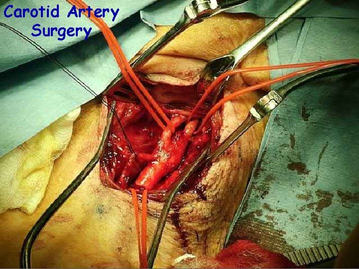 Carotid Artery Surgery 