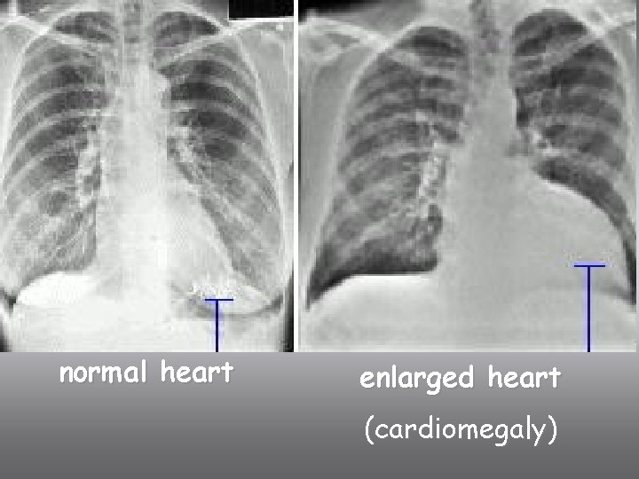 normal heart enlarged heart (cardiomegaly) 