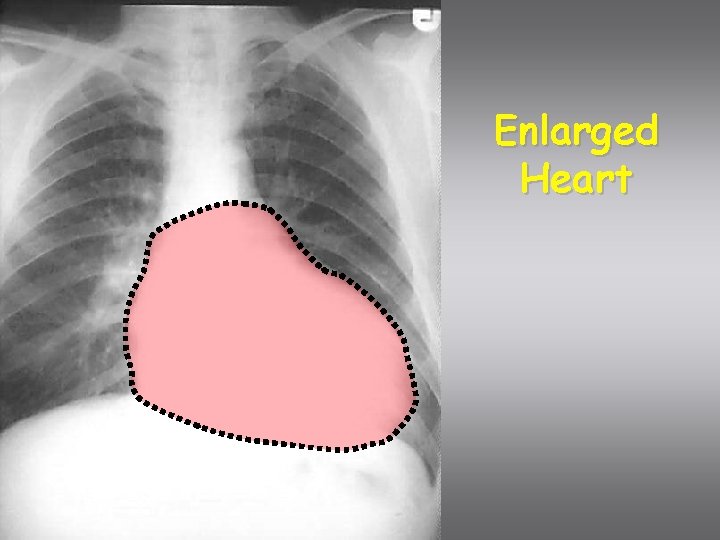 Enlarged Heart 