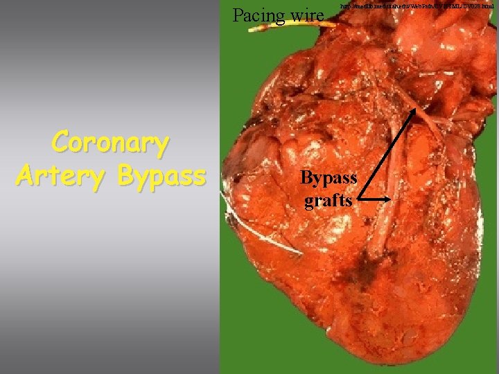 Pacing wire Coronary Artery Bypass http: //medlib. med. utah. edu/Web. Path/CVHTML/CV 028. html Bypass