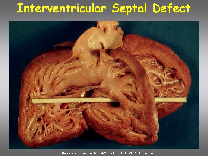 Interventricular Septal Defect http: //www-medlib. med. utah. edu/Web. Path/ATHHTML/ATH 014. html 