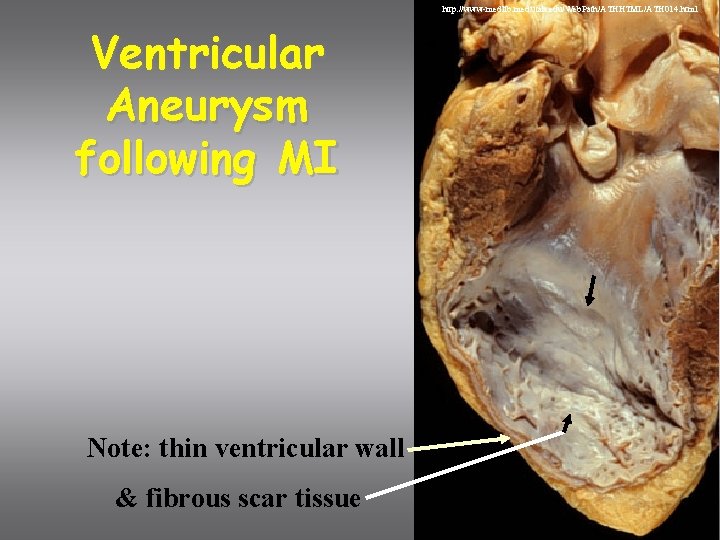 http: //www-medlib. med. utah. edu/Web. Path/ATHHTML/ATH 014. html Ventricular Aneurysm following MI Note: thin