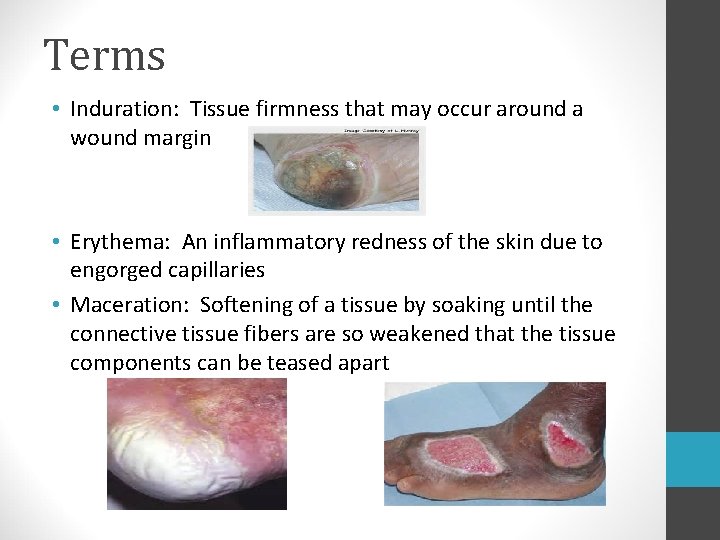 Terms • Induration: Tissue firmness that may occur around a wound margin • Erythema: Terms • Induration: Tissue firmness that may occur around a wound margin • Erythema:
