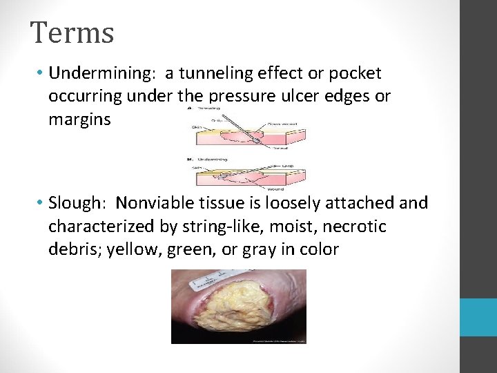 Terms • Undermining: a tunneling effect or pocket occurring under the pressure ulcer edges Terms • Undermining: a tunneling effect or pocket occurring under the pressure ulcer edges