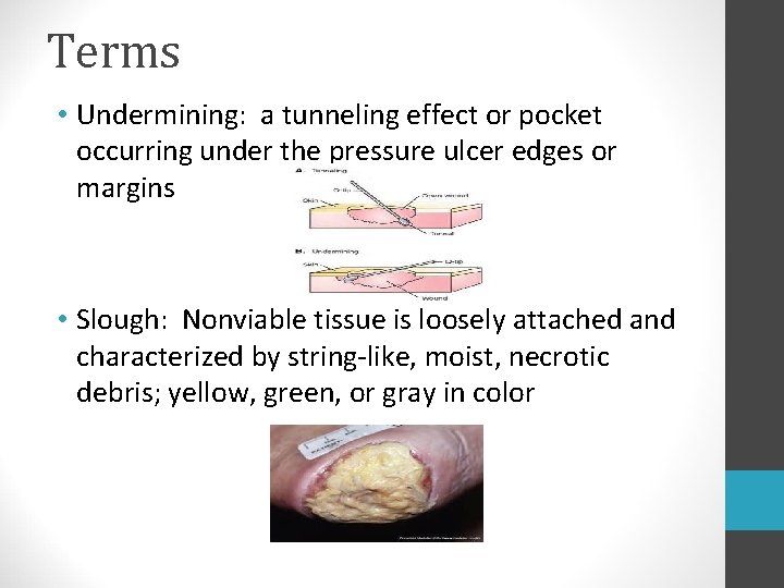 Terms • Undermining: a tunneling effect or pocket occurring under the pressure ulcer edges