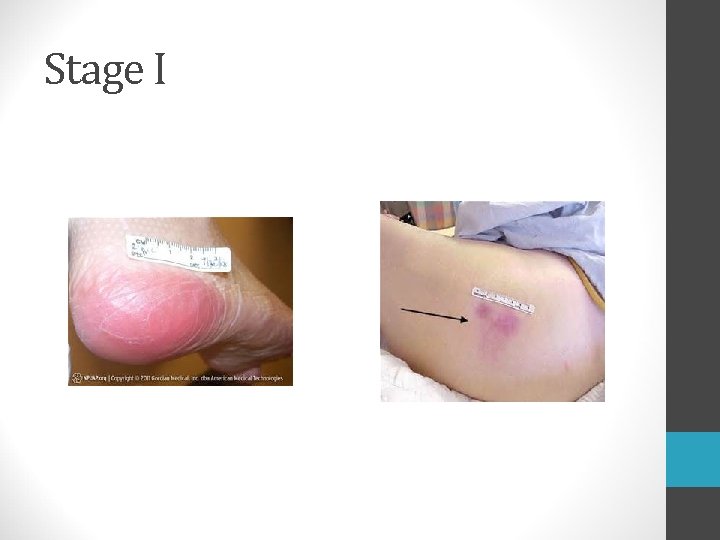 Stage I  Stage I