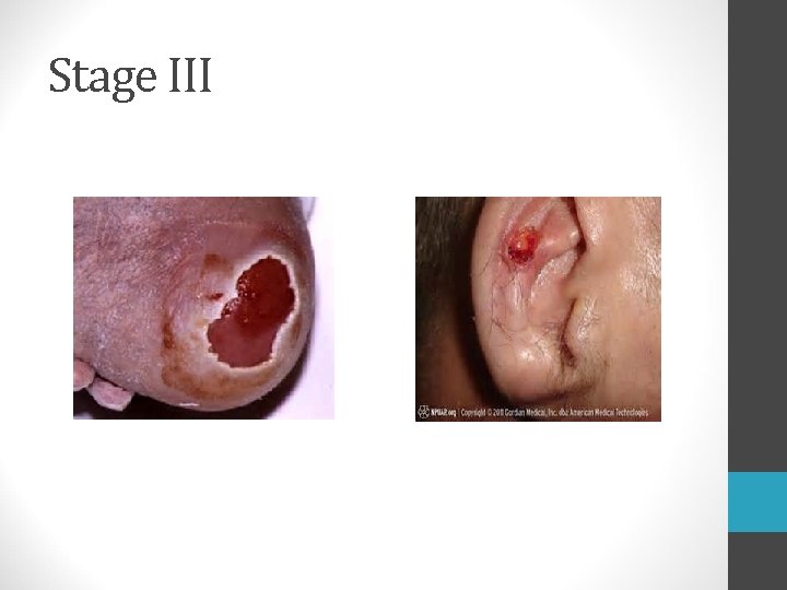 Stage III  Stage III