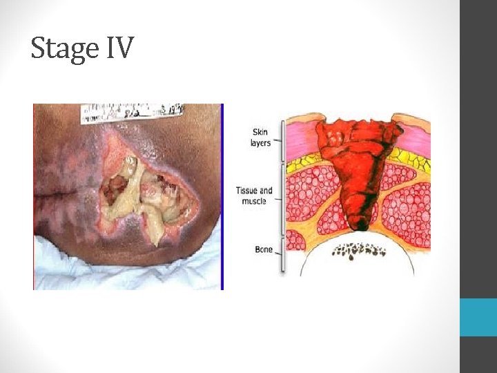 Stage IV  Stage IV