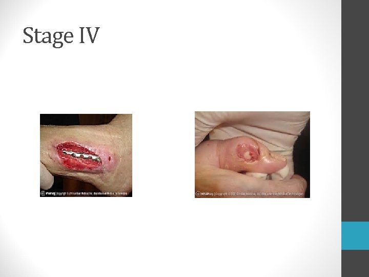 Stage IV  Stage IV