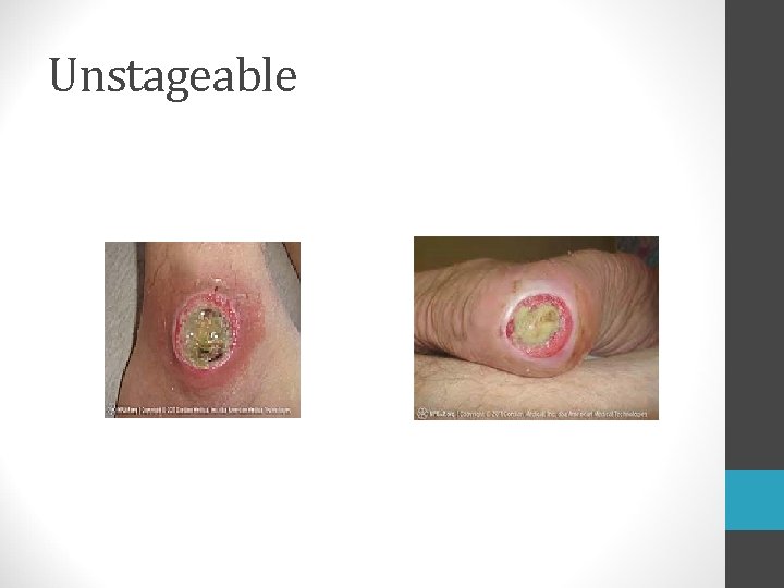 Unstageable  Unstageable