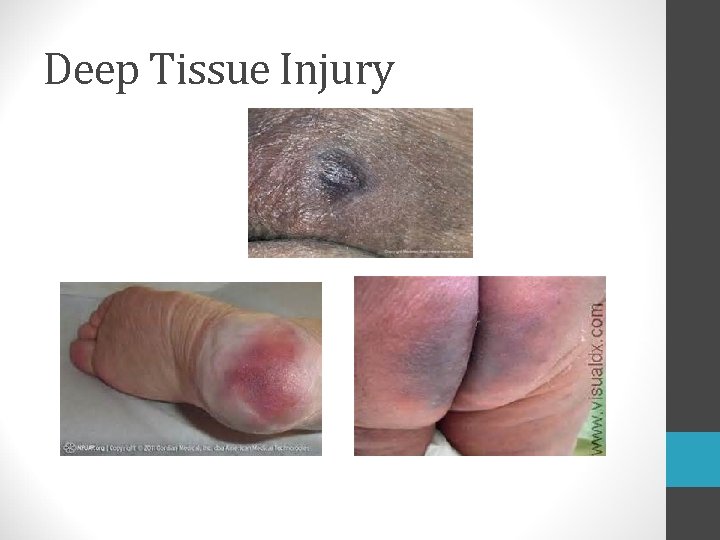 Deep Tissue Injury 